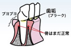 歯周病初期のイラスト